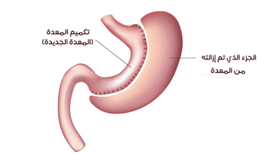 تكميم المعدة بالمنظار تكميم المعدة بالمنظار