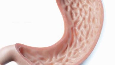 تكميم المعدة بدون جراحة