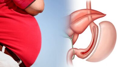 هل عملية تكميم المعدة لها أضرار هل عملية تكميم المعدة لها اضرار