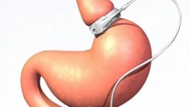 سعر عملية تدبيس المعدة سعر عملية تدبيس المعدة