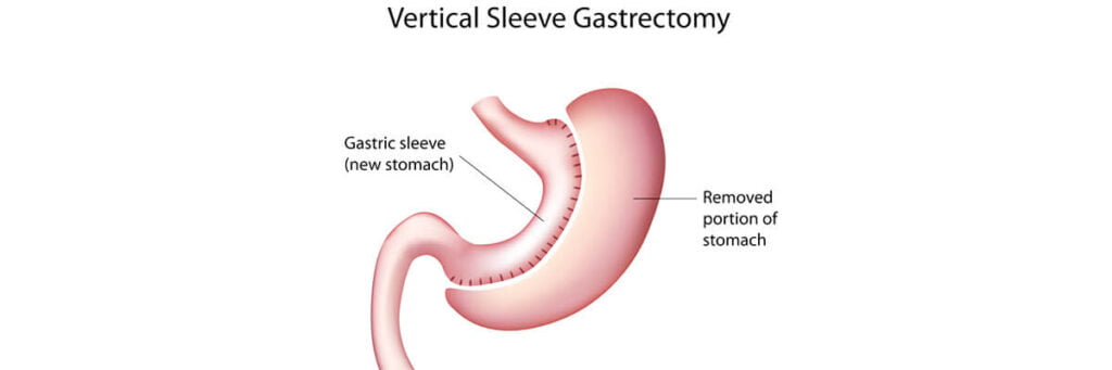 تكميم المعدة كم سعرها مخاطر عملية تكميم المعدة