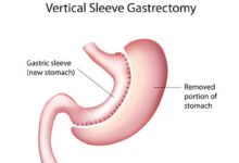 تكميم المعدة و الحمل مخاطر عملية تكميم المعدة
