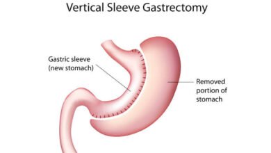 طرق تكميم المعدة مخاطر عملية تكميم المعدة