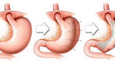 هل تكميم المعده حرام هل تكميم المعده حرام