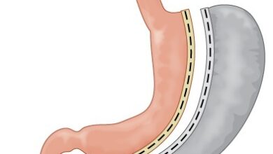 هل تكميم المعده له اضرار