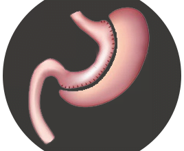 هل تكميم المعده مضر ما هى جراحة تكميم المعدة